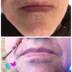 diolase-com-sista-guzellik-jet-lazer-laser-hair-removal-lazer-epilasyon-jet-laser-lazer-cihazi-01 diolase-com-sista-guzellik-jet-lazer-laser-hair-removal-lazer-epilasyon-jet-laser-lazer-cihazi-01