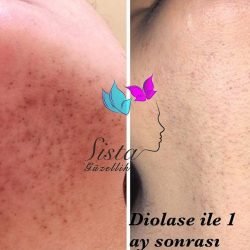 diolase-com-sista-guzellik-jet-lazer-laser-hair-removal-lazer-epilasyon-jet-laser-lazer-cihazi-device diolase-com-sista-guzellik-jet-lazer-laser-hair-removal-lazer-epilasyon-jet-laser-lazer-cihazi-device