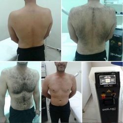 diolase-com-yesilcam-guzellik-jet-lazer-laser-hair-removal-lazer-epilasyon-jet-laser-lazer-cihazi-device-diyot-diode-diod-diot-lazer-epilasyon-cihazlari-makineleri-01